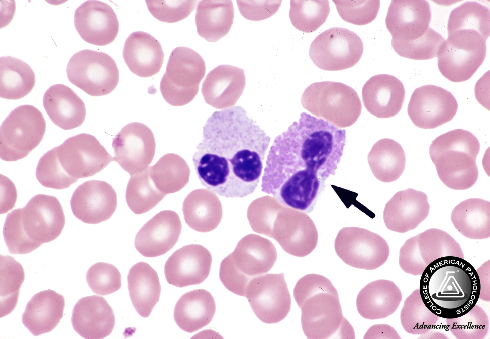 cap hematology images